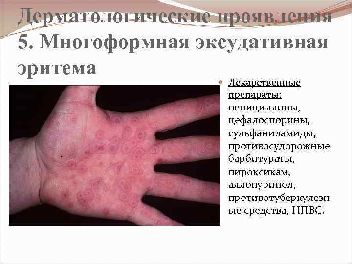 Дерматологические проявления 5. Многоформная эксудативная эритема Лекарственные препараты: пенициллины, цефалоспорины, сульфаниламиды, противосудорожные барбитураты, пироксикам,