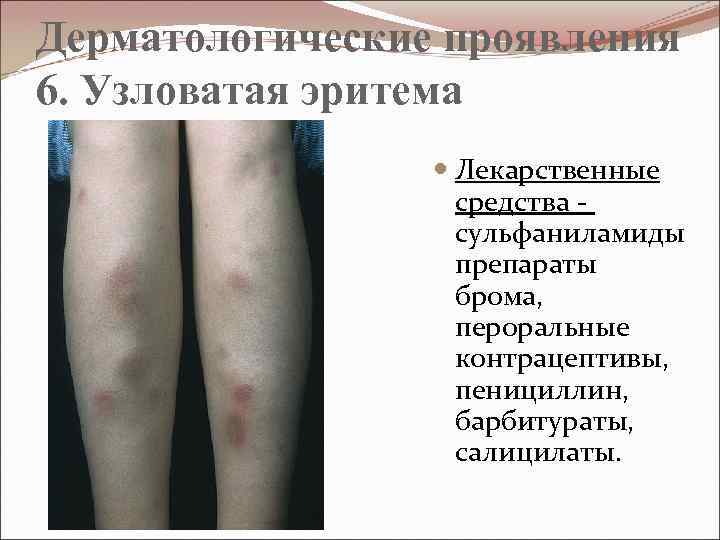 Дерматологические проявления 6. Узловатая эритема Лекарственные средства - сульфаниламиды препараты брома, пероральные контрацептивы, пенициллин,