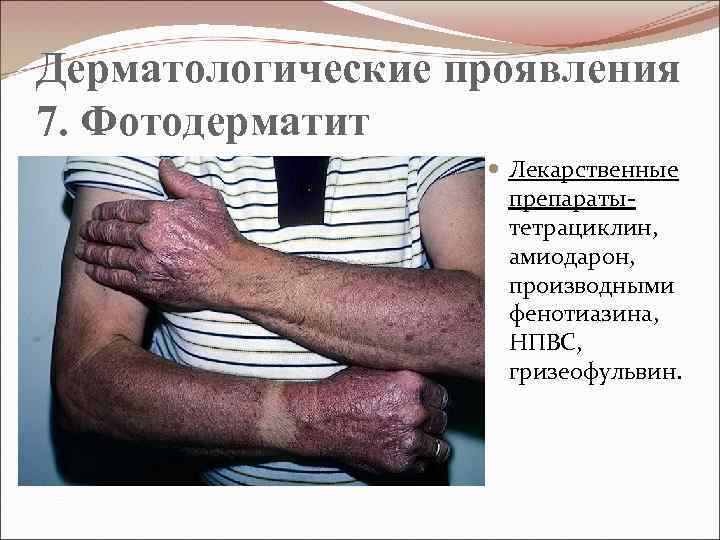 Дерматологические проявления 7. Фотодерматит Лекарственные препараты- тетрациклин, амиодарон, производными фенотиазина, НПВС, гризеофульвин. 