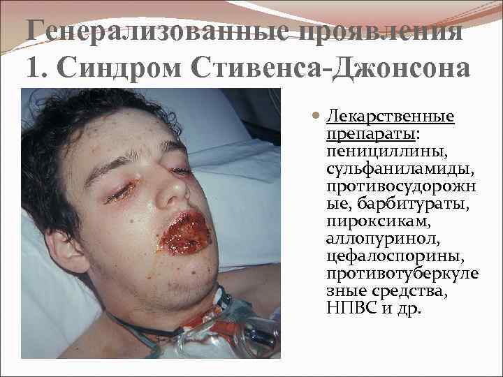 Генерализованные проявления 1. Синдром Стивенса-Джонсона Лекарственные препараты: пенициллины, сульфаниламиды, противосудорожн ые, барбитураты, пироксикам, аллопуринол,