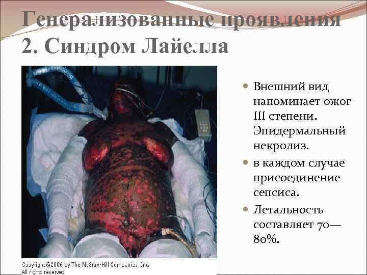 Генерализованные проявления 2. Синдром Лайелла Внешний вид напоминает ожог III степени. Эпидермальный некролиз. в