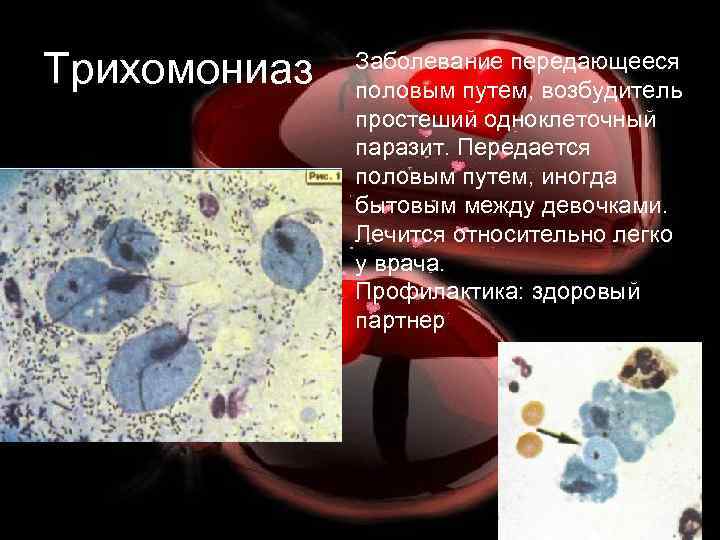 Трихомониаз Заболевание передающееся половым путем, возбудитель простеший одноклеточный паразит. Передается половым путем, иногда бытовым