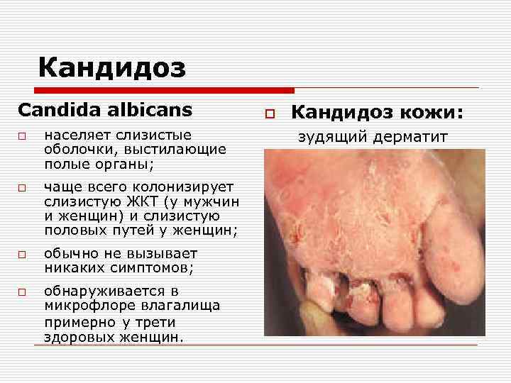 Кандидоз Candida albicans o o населяет слизистые оболочки, выстилающие полые органы; чаще всего колонизирует