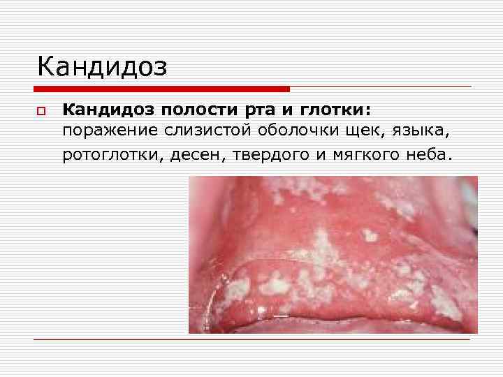 Кандидоз o Кандидоз полости рта и глотки: поражение слизистой оболочки щек, языка, ротоглотки, десен,