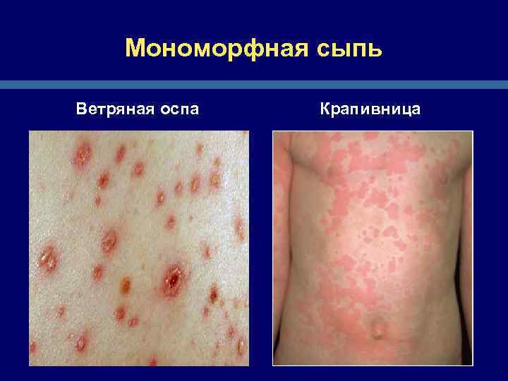 Мономорфная сыпь Ветряная оспа Крапивница 