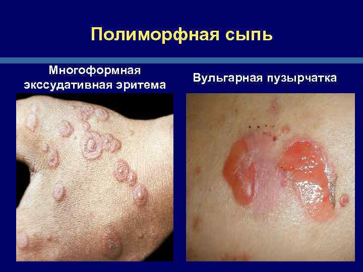 Полиморфная сыпь Многоформная экссудативная эритема Вульгарная пузырчатка 