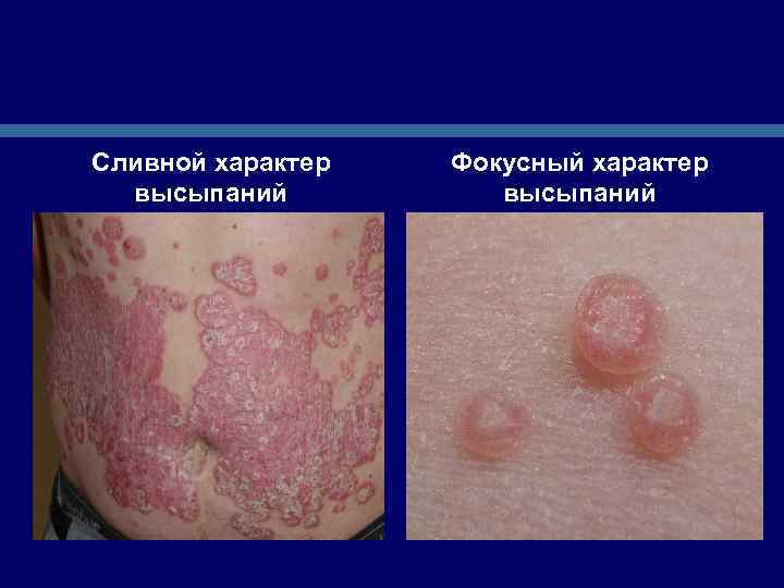 Сливной характер высыпаний Фокусный характер высыпаний 