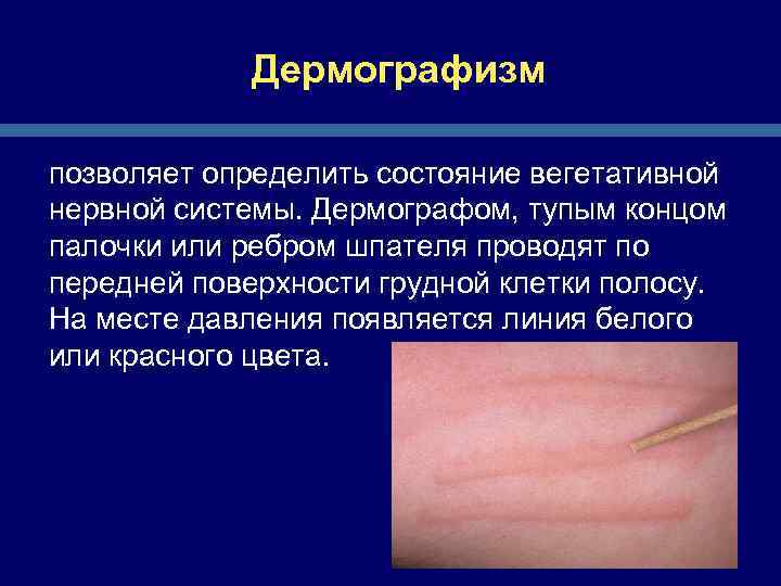 Дермографизм позволяет определить состояние вегетативной нервной системы. Дермографом, тупым концом палочки или ребром шпателя