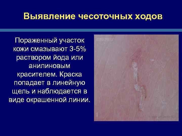 Выявление чесоточных ходов Пораженный участок кожи смазывают 3 -5% раствором йода или анилиновым красителем.