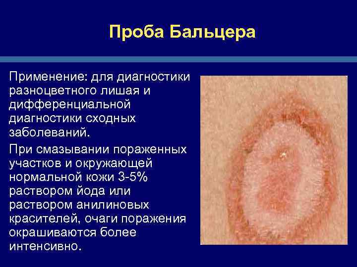 Проба Бальцера Применение: для диагностики разноцветного лишая и дифференциальной диагностики сходных заболеваний. При смазывании