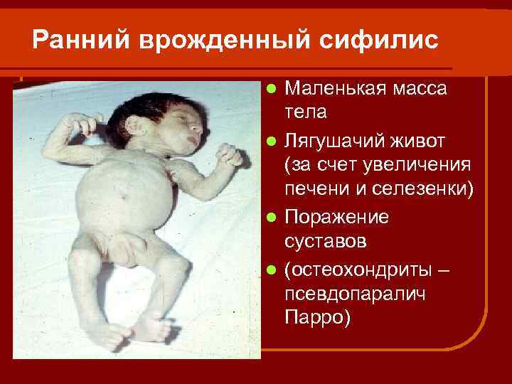 Ранний врожденный сифилис Маленькая масса тела l Лягушачий живот (за счет увеличения печени и