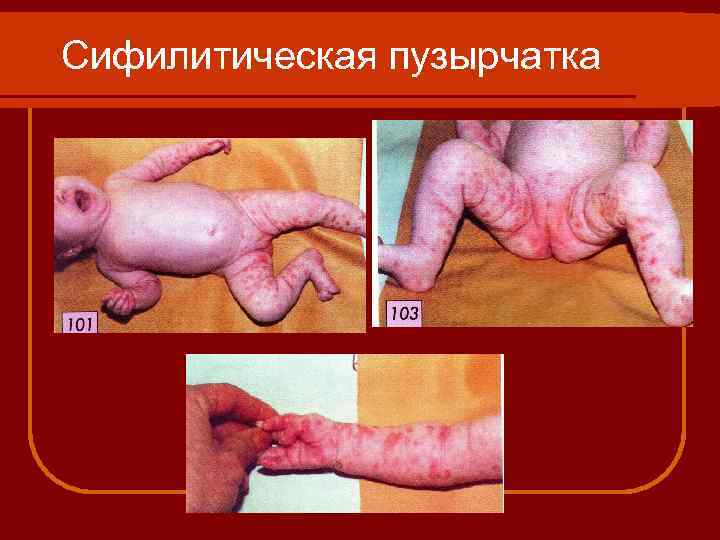Сифилитическая пузырчатка 