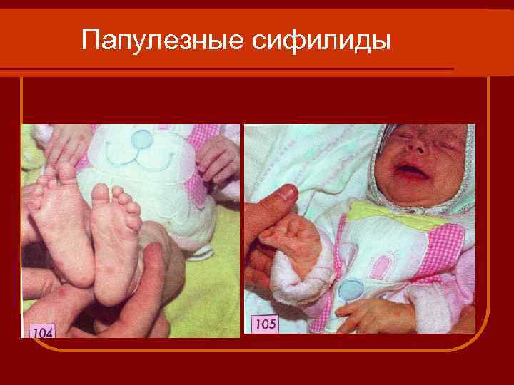 Папулезные сифилиды 