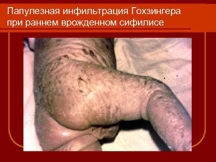 Папулезная инфильтрация Гохзингера при раннем врожденном сифилисе 