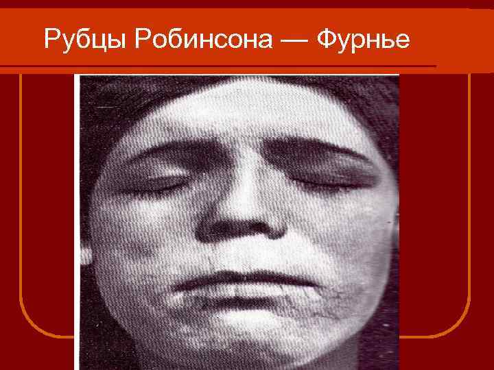 Рубцы Робинсона — Фурнье 