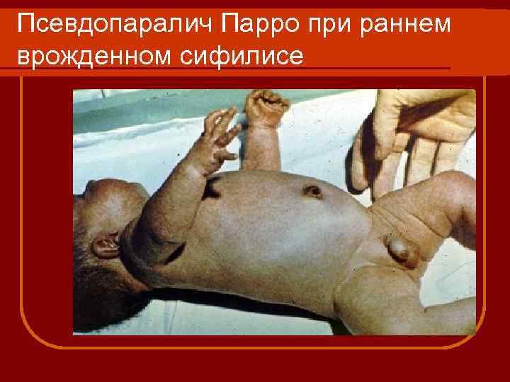 Псевдопаралич Парро при раннем врожденном сифилисе 