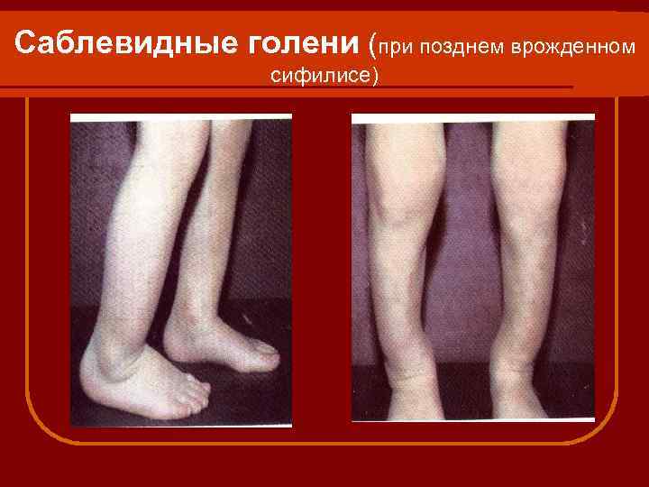 Саблевидные голени (при позднем врожденном сифилисе) 
