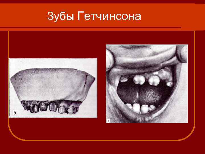 Зубы Гетчинсона 