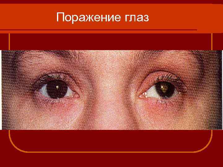 Поражение глаз 