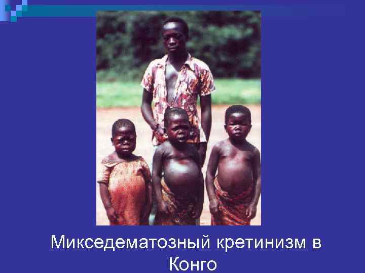 Микседематозный кретинизм в Конго 
