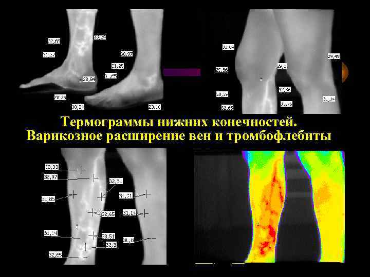 Термограммы нижних конечностей. Варикозное расширение вен и тромбофлебиты 