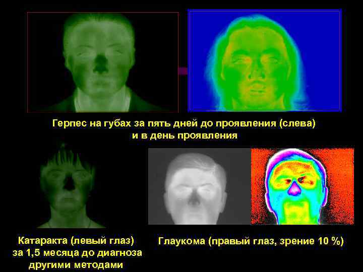Герпес на губах за пять дней до проявления (слева) и в день проявления Катаракта