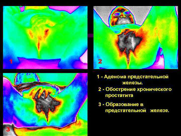 1 2 1 - Аденома предстательной железы. 2 - Обострение хронического простатита 3 -