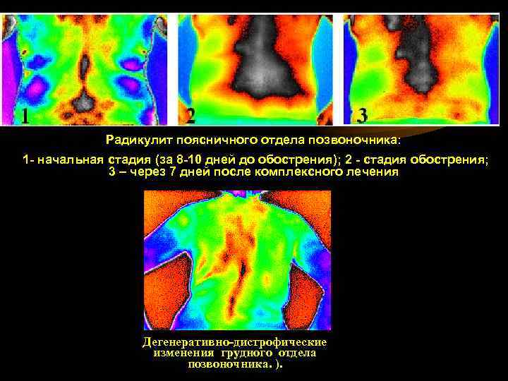 Радикулит поясничного отдела позвоночника: 1 - начальная стадия (за 8 -10 дней до обострения);