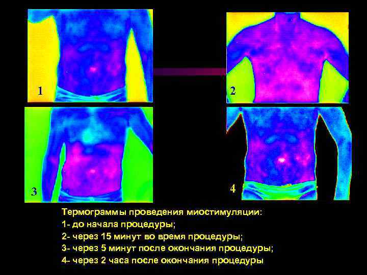 1 3 2 4 Термограммы проведения миостимуляции: 1 - до начала процедуры; 2 -