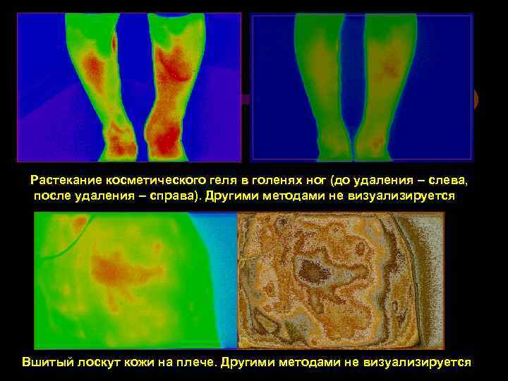 Растекание косметического геля в голенях ног (до удаления – слева, после удаления – справа).