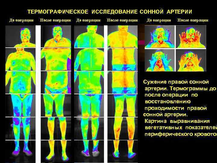 ТЕРМОГРАФИЧЕСКОЕ ИССЛЕДОВАНИЕ СОННОЙ АРТЕРИИ До операции После операции Сужение правой сонной артерии. Термограммы до