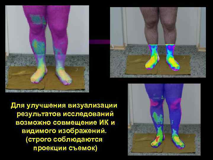 Для улучшения визуализации результатов исследований возможно совмещение ИК и видимого изображений. (строго соблюдаются проекции