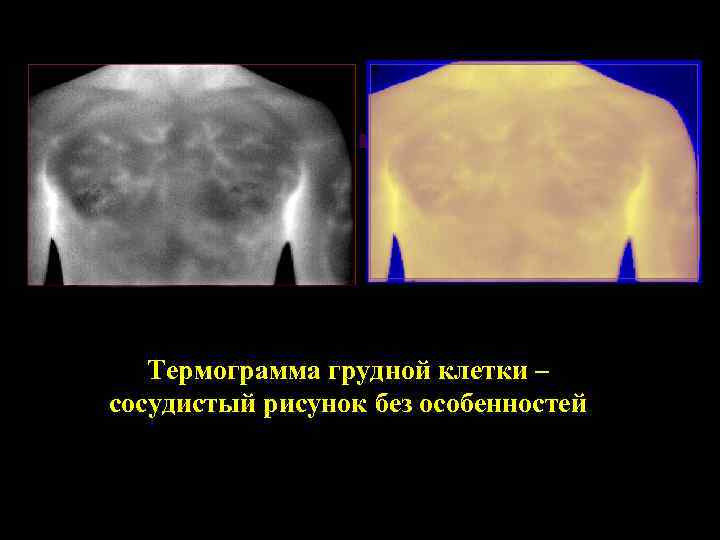 Термограмма грудной клетки – сосудистый рисунок без особенностей 