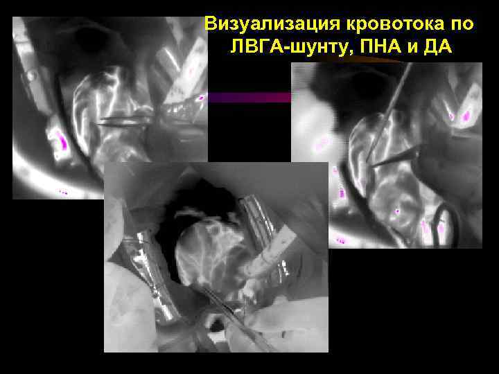 Визуализация кровотока по ЛВГА-шунту, ПНА и ДА 