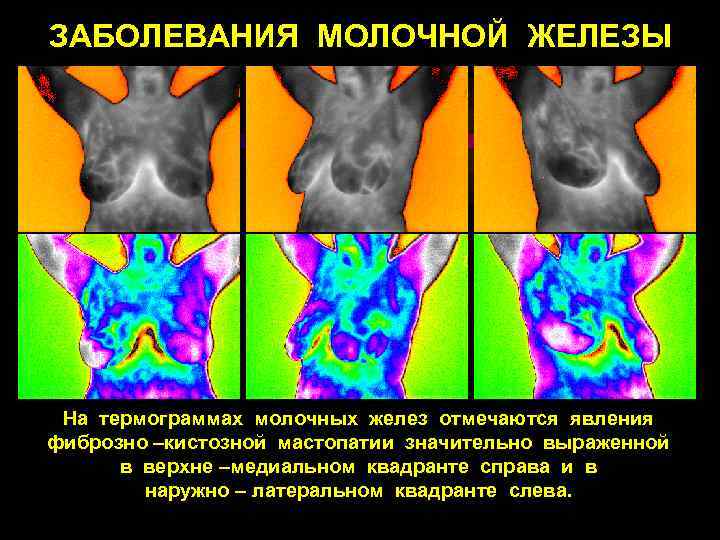 ЗАБОЛЕВАНИЯ МОЛОЧНОЙ ЖЕЛЕЗЫ На термограммах молочных желез отмечаются явления фиброзно –кистозной мастопатии значительно выраженной