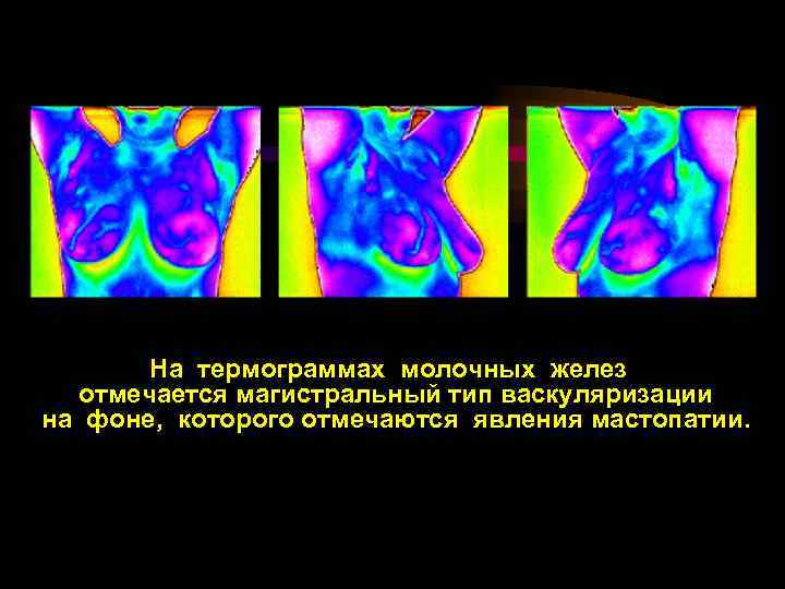 На термограммах молочных желез отмечается магистральный тип васкуляризации на фоне, которого отмечаются явления мастопатии.