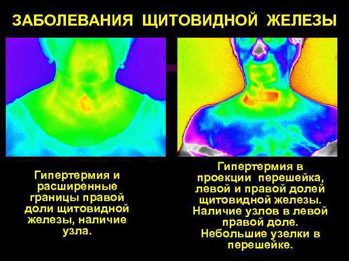 ЗАБОЛЕВАНИЯ ЩИТОВИДНОЙ ЖЕЛЕЗЫ Гипертермия и расширенные границы правой доли щитовидной железы, наличие узла. Гипертермия