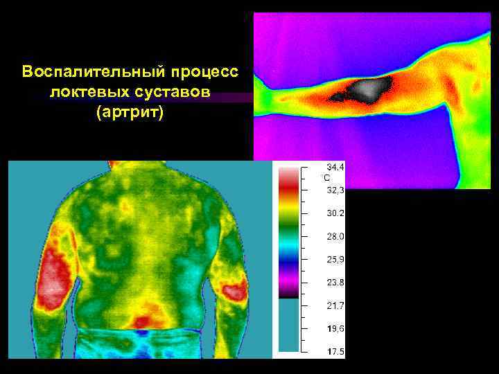 Воспалительный процесс локтевых суставов (артрит) 