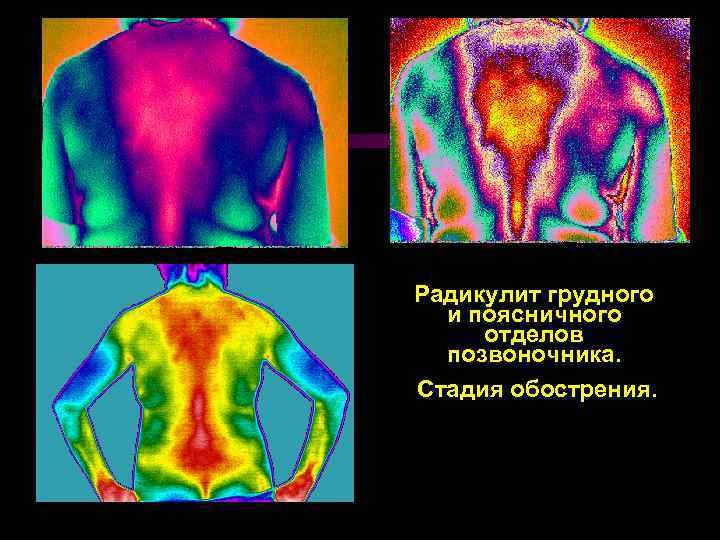 Радикулит грудного и поясничного отделов позвоночника. Стадия обострения. 