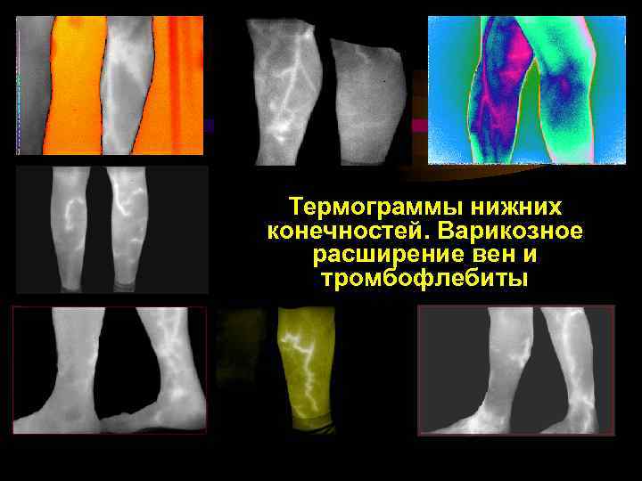 Термограммы нижних конечностей. Варикозное расширение вен и тромбофлебиты 
