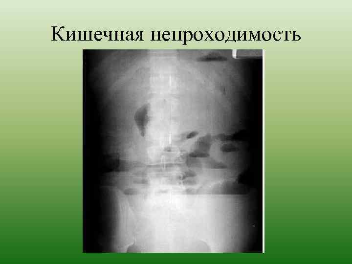 Кишечная непроходимость 