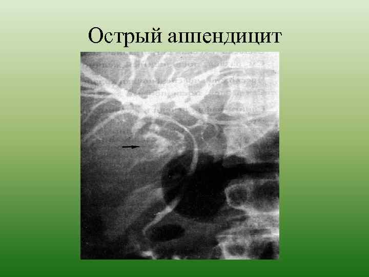 Острый аппендицит 
