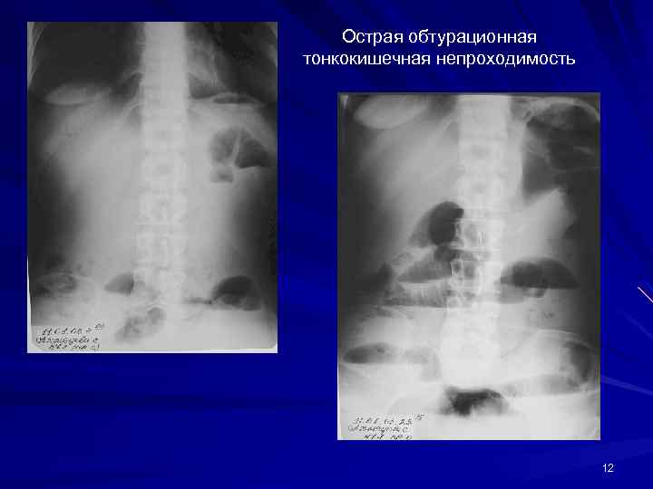 Острая обтурационная тонкокишечная непроходимость 12 