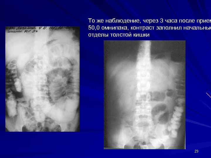 То же наблюдение, через 3 часа после прием 50, 0 омнипака, контраст заполнил начальные