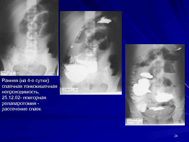 Ранняя (на 4 -е сутки) спаечная тонкокишечная непроходимость, 25. 12. 02 - повторная релапаротомия