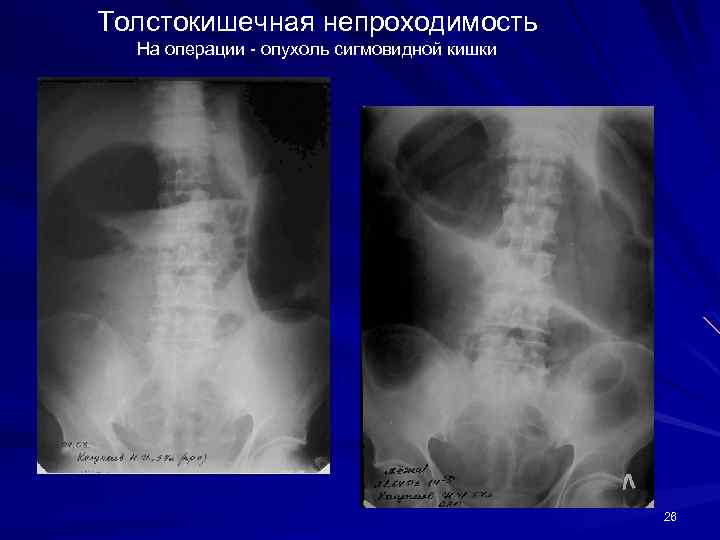 Толстокишечная непроходимость На операции - опухоль сигмовидной кишки 26 