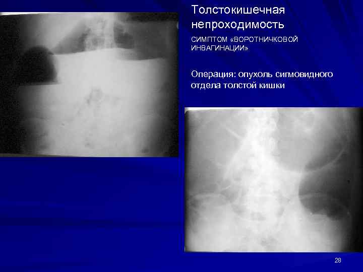 Толстокишечная непроходимость СИМПТОМ «ВОРОТНИЧКОВОЙ ИНВАГИНАЦИИ» Операция: опухоль сигмовидного отдела толстой кишки 28 