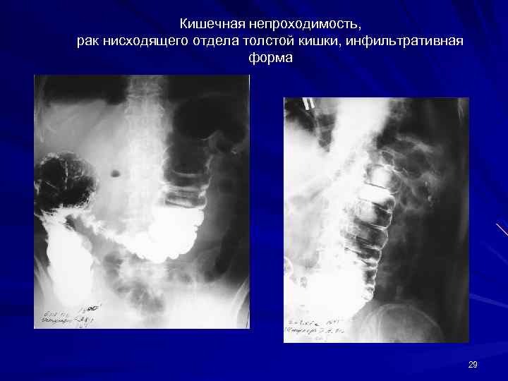 Кишечная непроходимость, рак нисходящего отдела толстой кишки, инфильтративная форма 29 