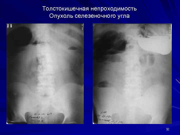 Толстокишечная непроходимость Опухоль селезеночного угла 32 