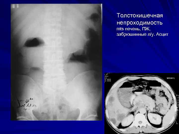 Толстокишечная непроходимость mts печень, ПЖ, забрюшинные л/у. Асцит 33 